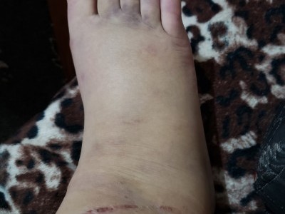 Urgent foot surgery