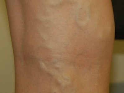 varicose veins surgery