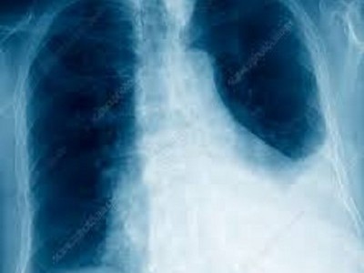 Save a brother of protracted Lungs infection