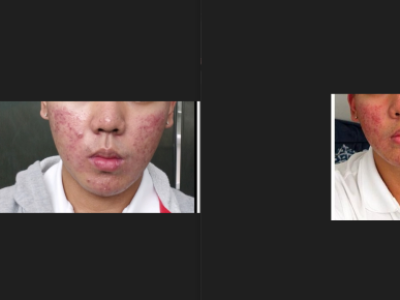 Accutane Expenses (Severe acne treatment)