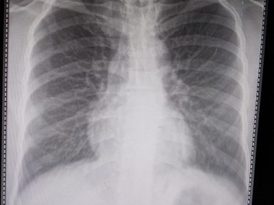 Help me treat acute pneumonia