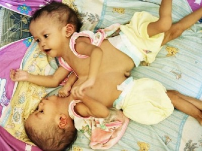 Help Separation Surgery of Twin Babies