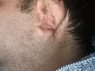 Urgently needed money for ear surgery