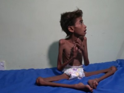 Little poor girl suffering from Malnutrition